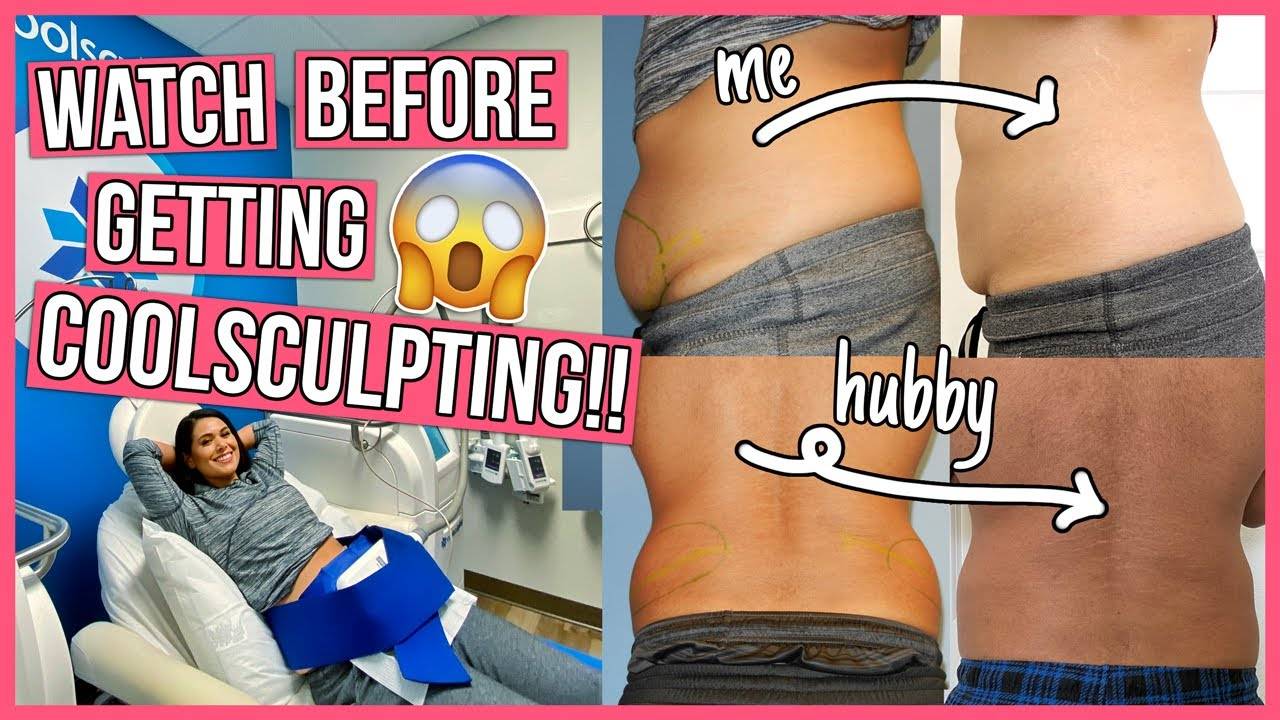Cool Sculpting Reviews (Before And After Pictures) Cost And Affect!