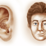 Ramsay Hunt Syndrome Wiki, Reddit, Cause, Curable, Recovery & Treatment!