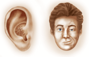 Ramsay Hunt Syndrome Wiki Reddit Cause Curable Recovery Treatment