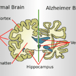 World Alzheimer’s Day: Alzheimer’s Disease Symptoms & Causes!