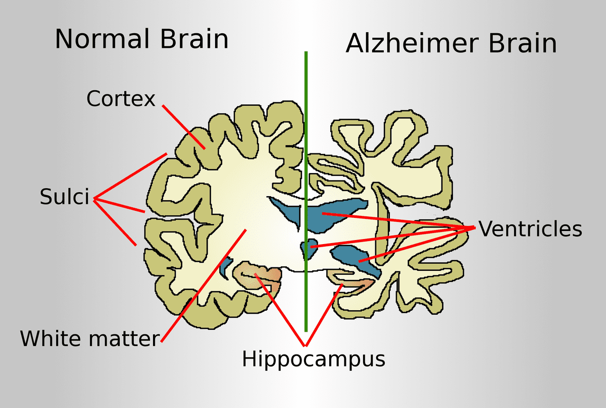 Alzheimers Disease