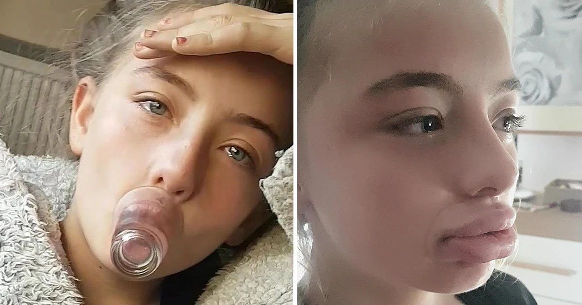 Kylie Jenner Lip Challenge (2022) Everything You Need To Know!