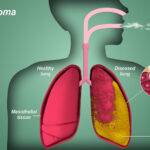 Mesothelioma Symptoms And Causes 2023: How To Cure?