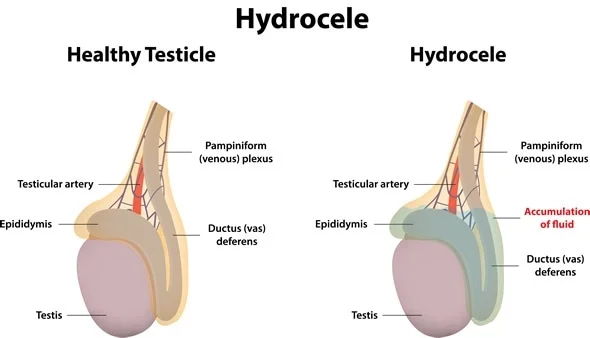 Hydrocele Medical Test