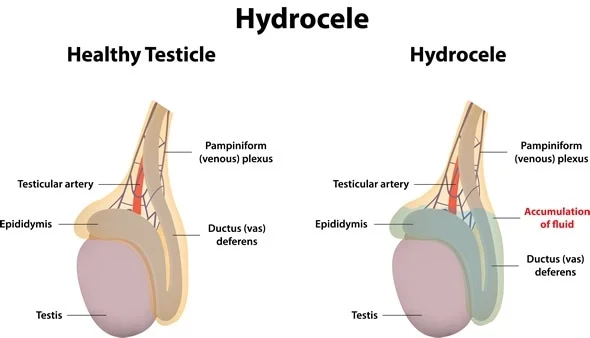 what-is-hydrocele-medical-test-in-hindi-tamil-army-2023